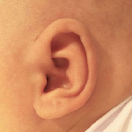 prominent extra fold of cartilage in the middle of the ear after treatment