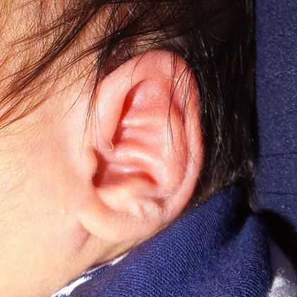 prominent extra fold of cartilage in the middle of the ear