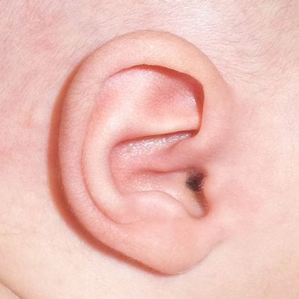 prominent ear after treatment