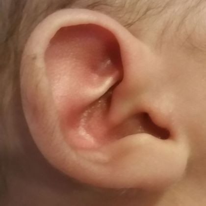 prominent ear before treatment