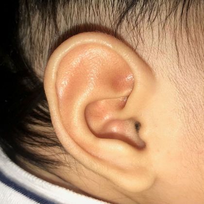 Stahl’s ear deformity after treatment