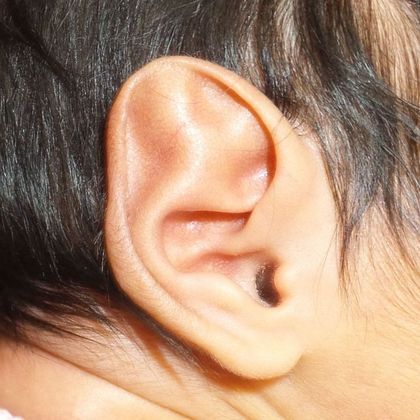 Stahl’s ear deformity before treatment