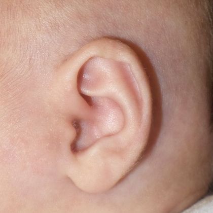 deformity of the outer ear cartilage after treatment