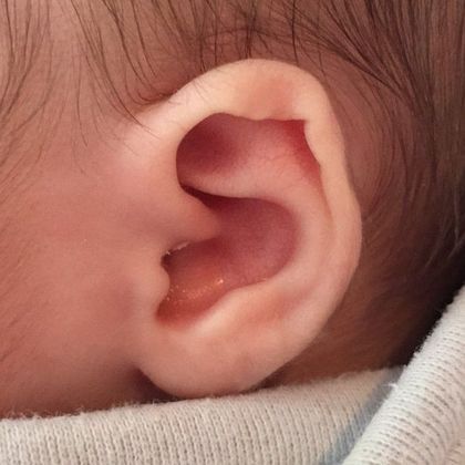 deformity of the outer ear cartilage before treatment