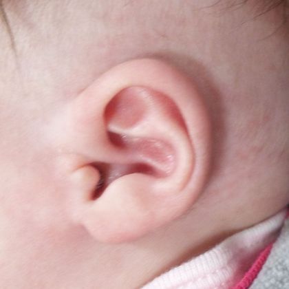 bent ear cartilage at birth after treatment