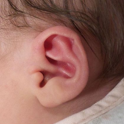 bent ear cartilage before treatment