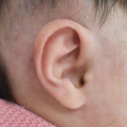 prominent ear deformity after treatment