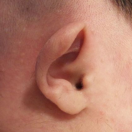 prominent ear deformity before treatment