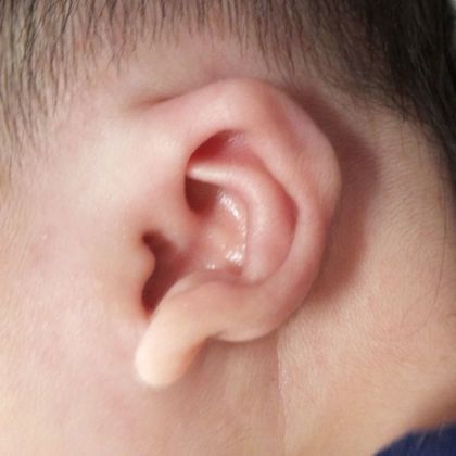 significant ear deformity after treatment