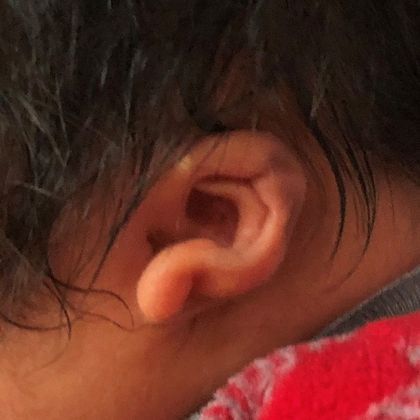 significant ear deformity before treatment