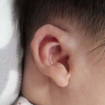 severely constricted ear deformity after treatment
