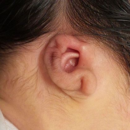 severely constricted ear deformity before treatment