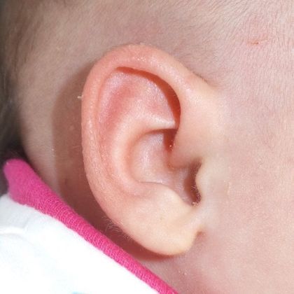prominent ears after treatment