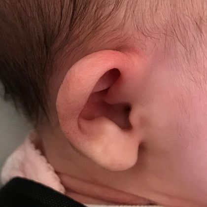 prominent ears before treatment