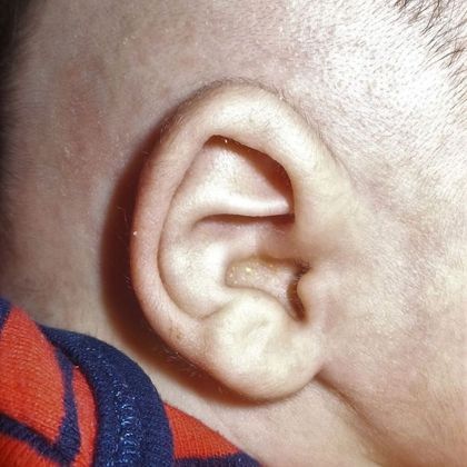 helical rim ear deformity after treatment