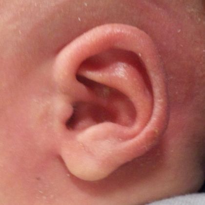 helical rim ear cartilage deformity after treatment