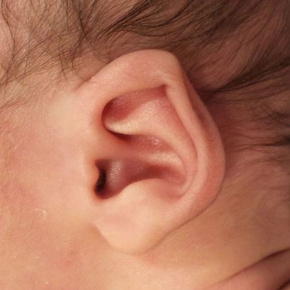 helical rim ear cartilage deformity before treatment