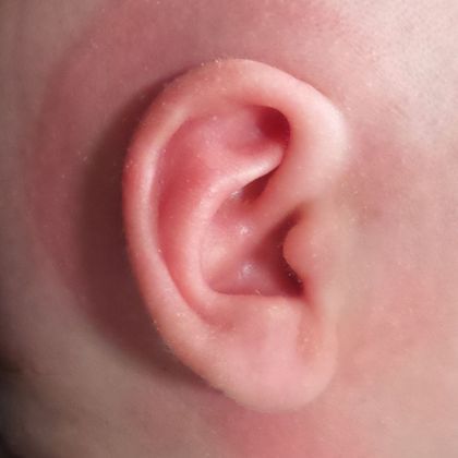 fused cartilage of the ear causing an ear deformity after treatment