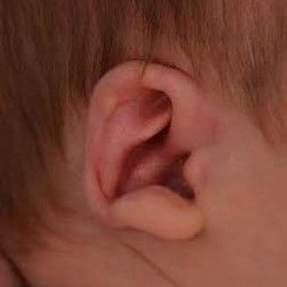 fused cartilage of the ear causing an ear deformity before treatment