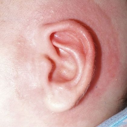 bent ear cartilage causing a constricted ear deformity after treatment