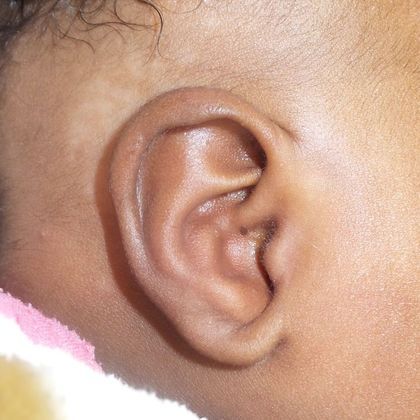 The shell-shaped bowl of the ear after treatment