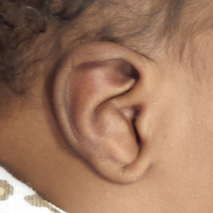 The shell-shaped bowl of the ear before treatment