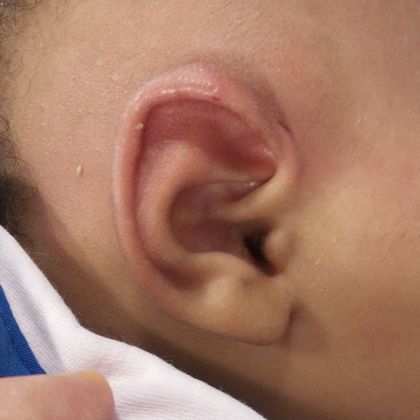 lidding deformity of the ear after treatment