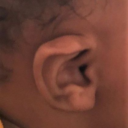 lidding deformity of the ear before treatment