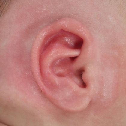 wavy ear cartilage at birth after treatment