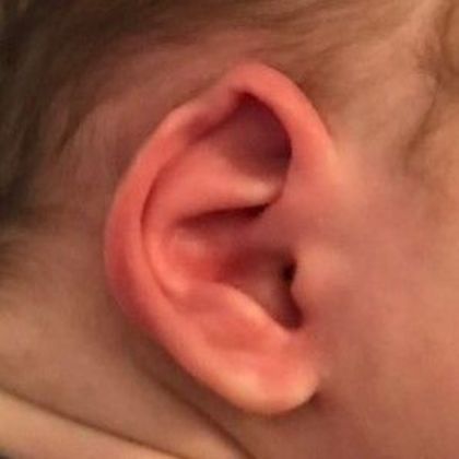 wavy ear cartilage at birth before treatment