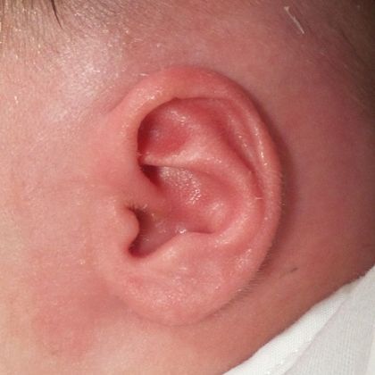 abnormal ear cartilage that was fused and constricted after treatment