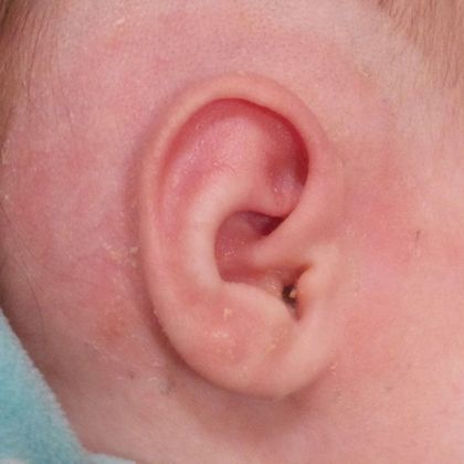 Spock ear, elf ear after treatment