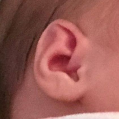 Spock ear, elf ear before treatment