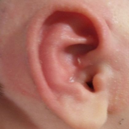 ear lidding deformity after treatment