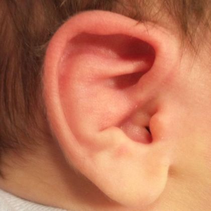 conchal crus and ear lidding deformity before treatment