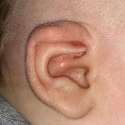 ear lidding deformity after treatment