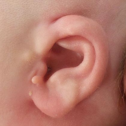 severe ear deformity with constricted ear cartilage after treatment
