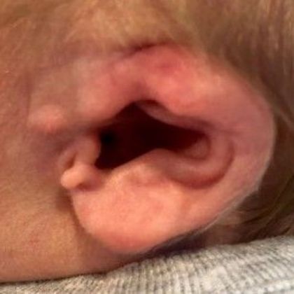 severe ear deformity with constricted ear cartilage before treatment