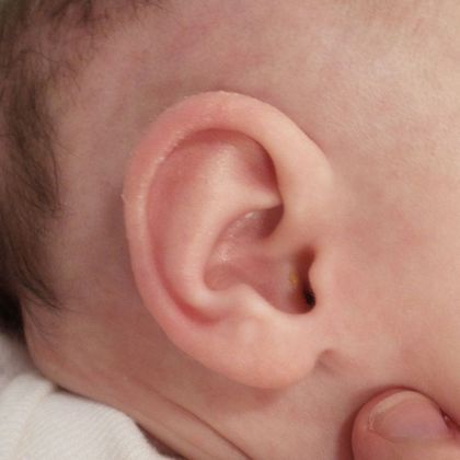 Stick out ear after treatment
