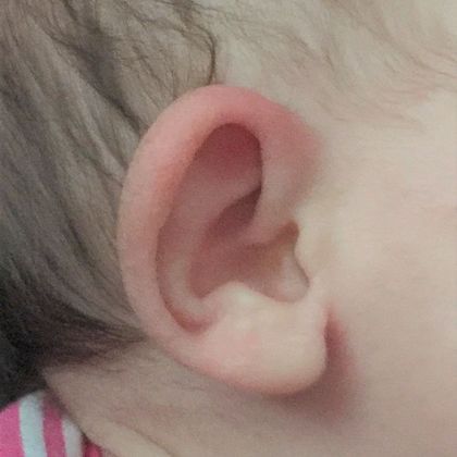 Stick out ear before treatment