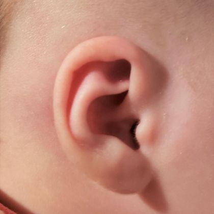 upper ear cartilage is buried underneath the skin after treatment