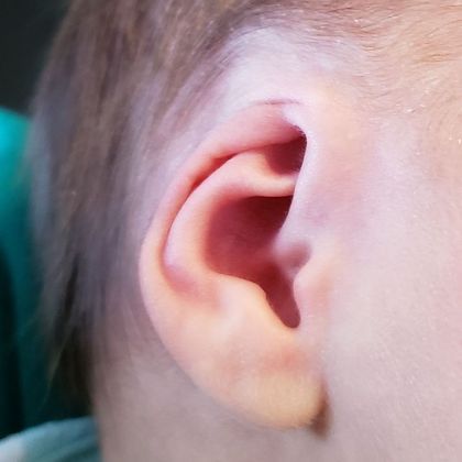 upper ear cartilage is buried underneath the skinbefore treatment