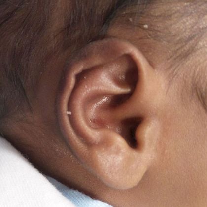 correction of bent ear cartilage before treatment
