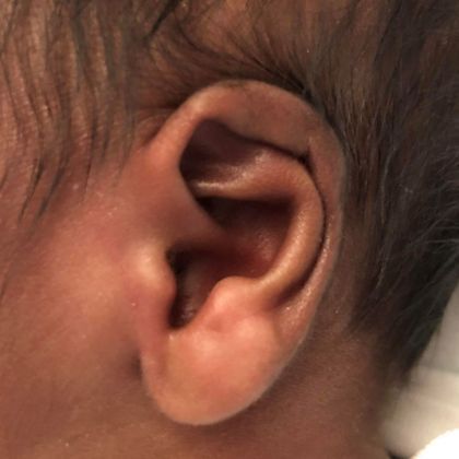 ear lidding deformity before treatment