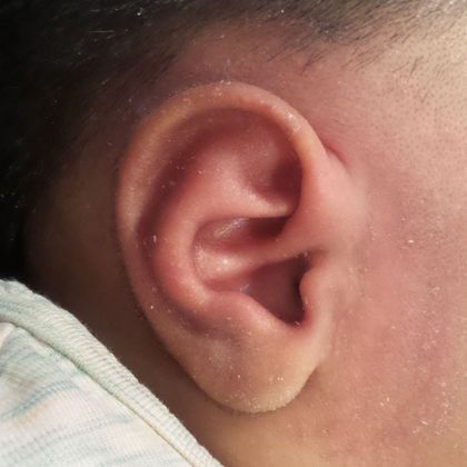 The helical rim of the ear did not have the normal bend after treatment