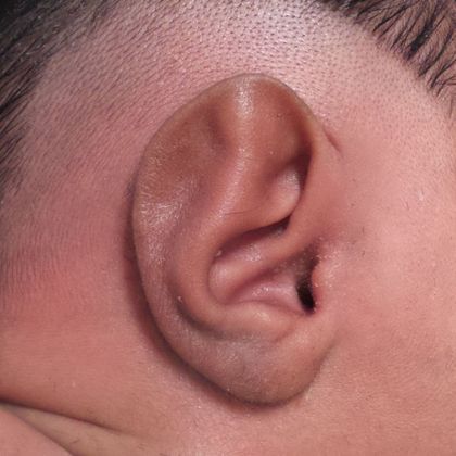 The helical rim of the ear did not have the normal bend before treatment