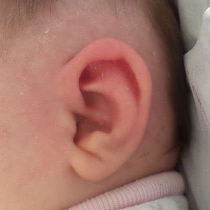 Conchal crus ear deformity after treatment