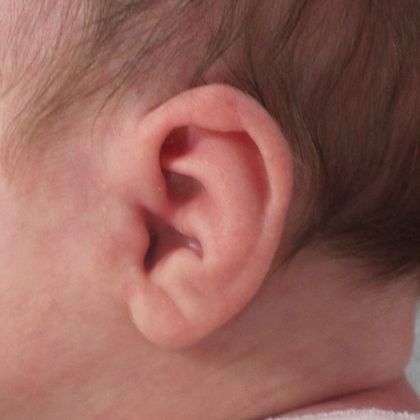 Conchal crus ear deformity before treatment