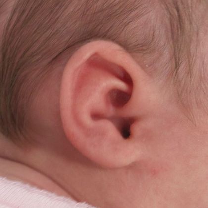 conchal crus ear deformity before treatment