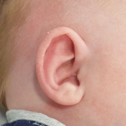 prominent ear deformity after treatment